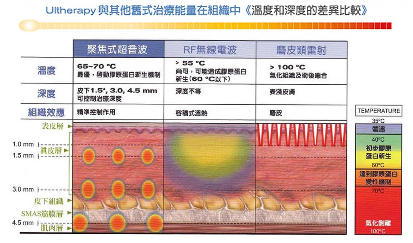 台中音波推薦,台中音波拉提,Ulthera 音波拉提