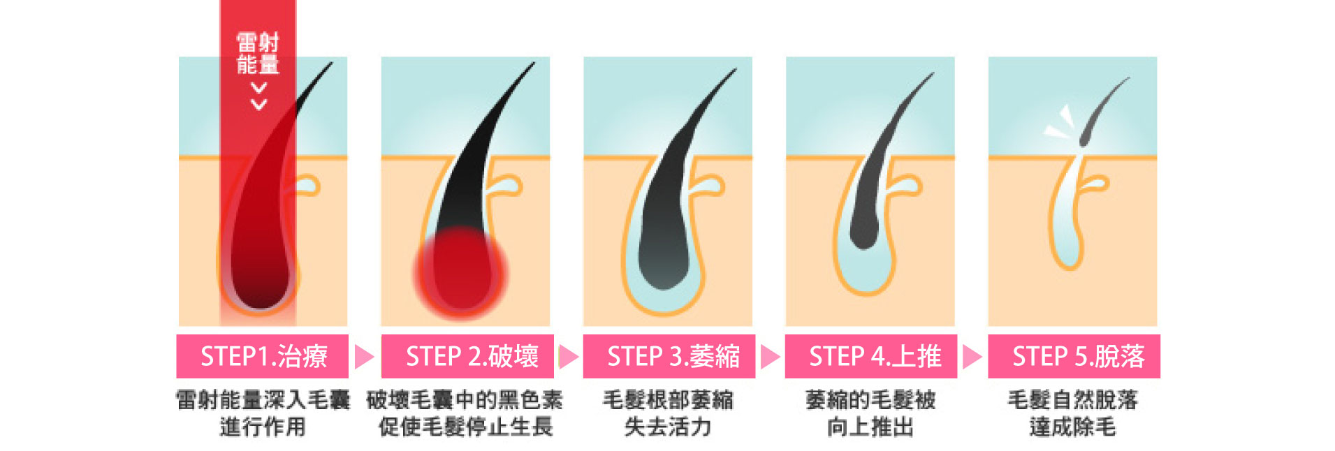 雷射除毛作用原理