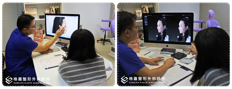 院長推薦的Bistool鼻模 是韓國新的矽膠鼻模