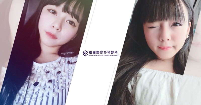 韓系美女-格嘉隆鼻案例