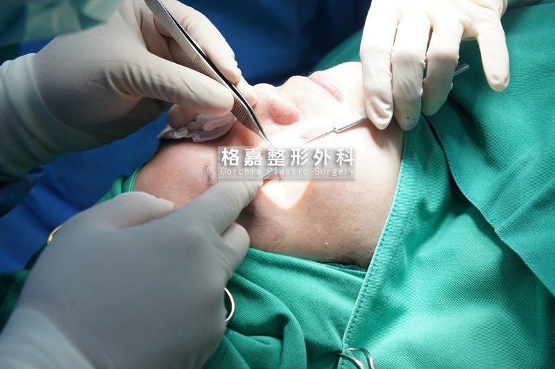 微雕眼袋移脂術-手術全程於無菌手術室中進行