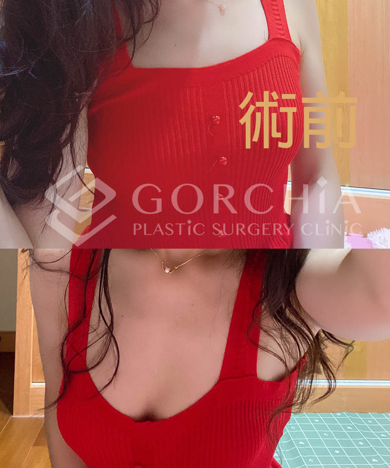 自體脂肪隆乳推薦-隆乳後三個月(格嘉自體脂肪隆乳案例分享)