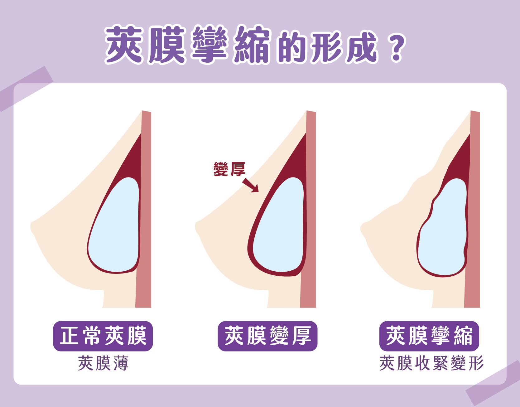 莢膜攣縮是什麼？