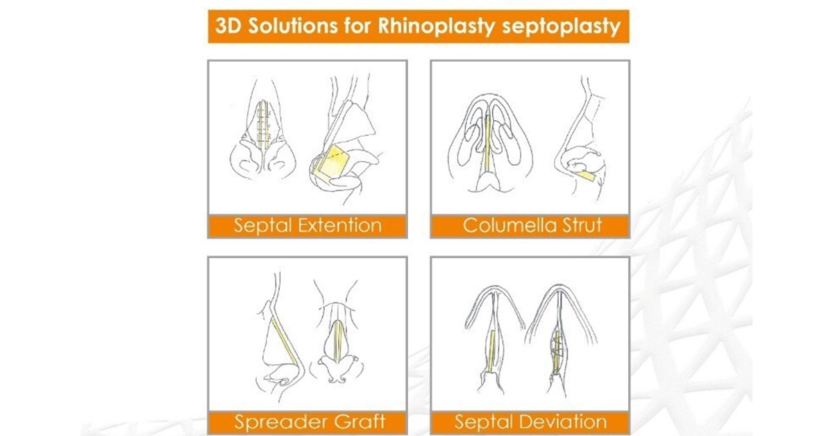 PCL (Osteopore)是如何應用在在隆鼻手術？