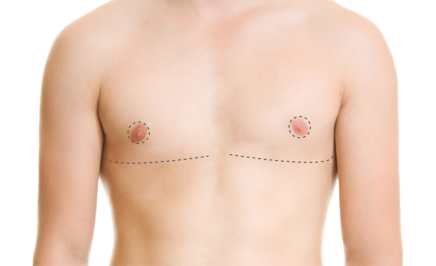 新式皮瓣平胸手術－格嘉專業平胸手術