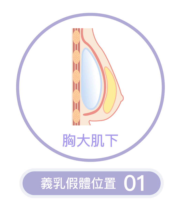 胸大肌下的義乳假體位置示意－格嘉隆乳手術推薦