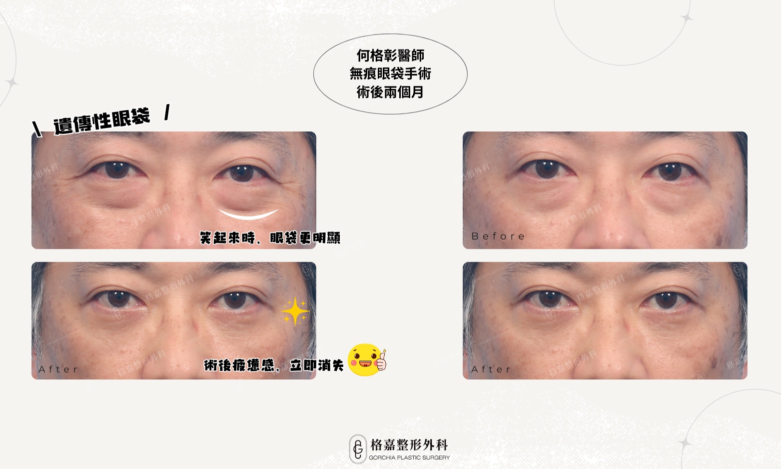 何格彰醫師眼袋案例